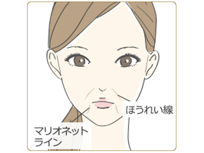 スレッドリフトの仕組み