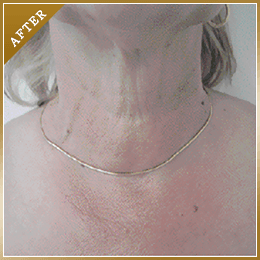 首のしわ治療の症例写真(AFTER)