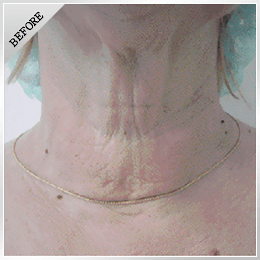首のしわ治療の症例写真(BEFORE)